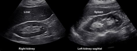 kub ultrasound normal results|Ultrasonography of the Kidney: A Pictorial Review .
